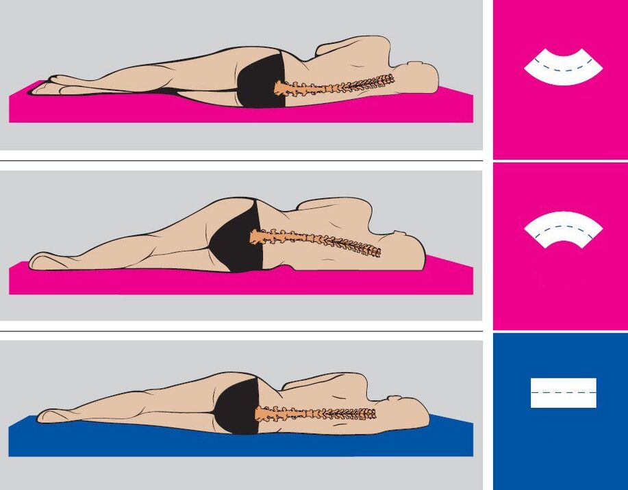 Lomber osteokondroz ile uyku sırasında doğru vücut pozisyonu