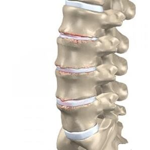 Osteokondrozun belirgin belirtileri olan lomber omurga