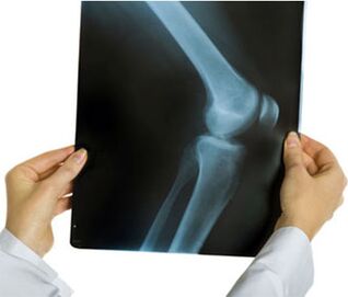 Diz ekleminin artrozunun röntgeni