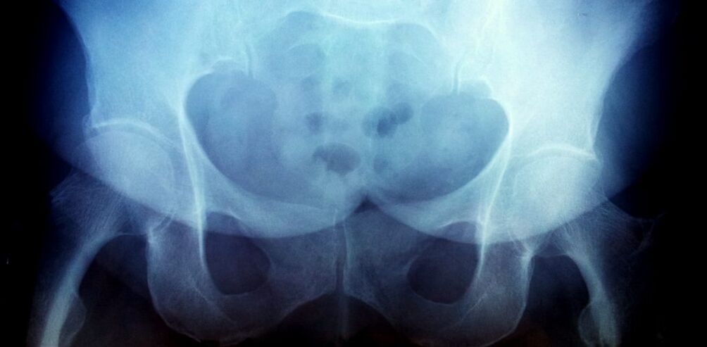 X -Ray Resim 2. Derece Arthroz